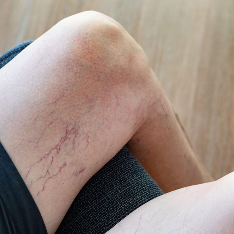 spider vein