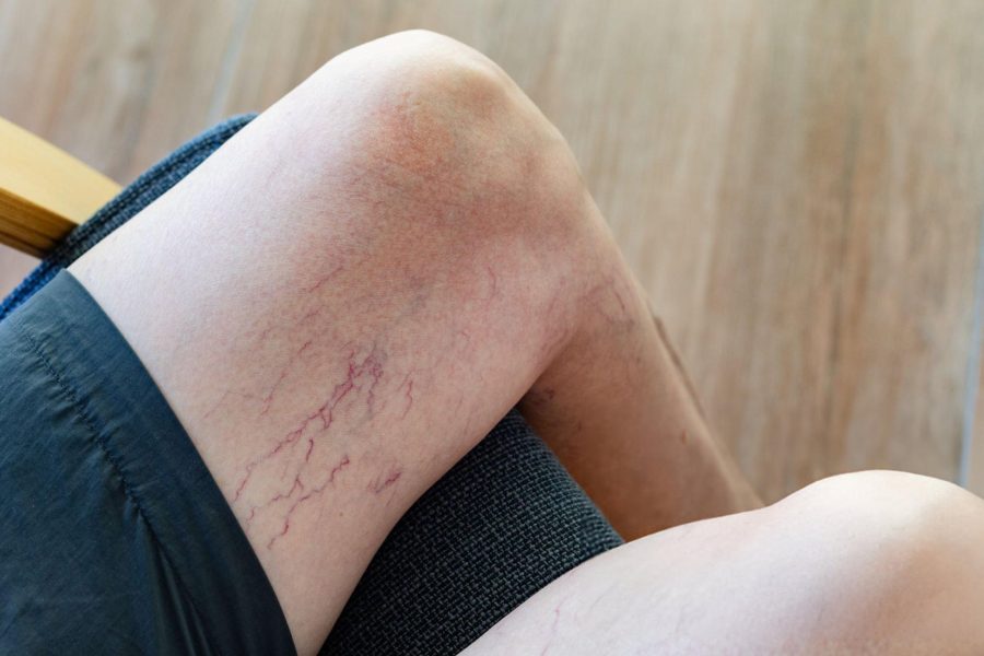 spider vein