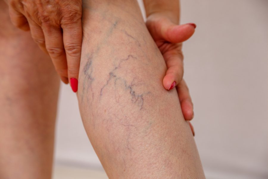 Vein Problems
