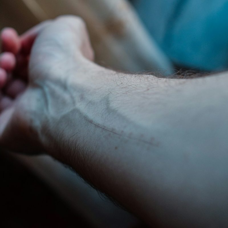 vein symptoms