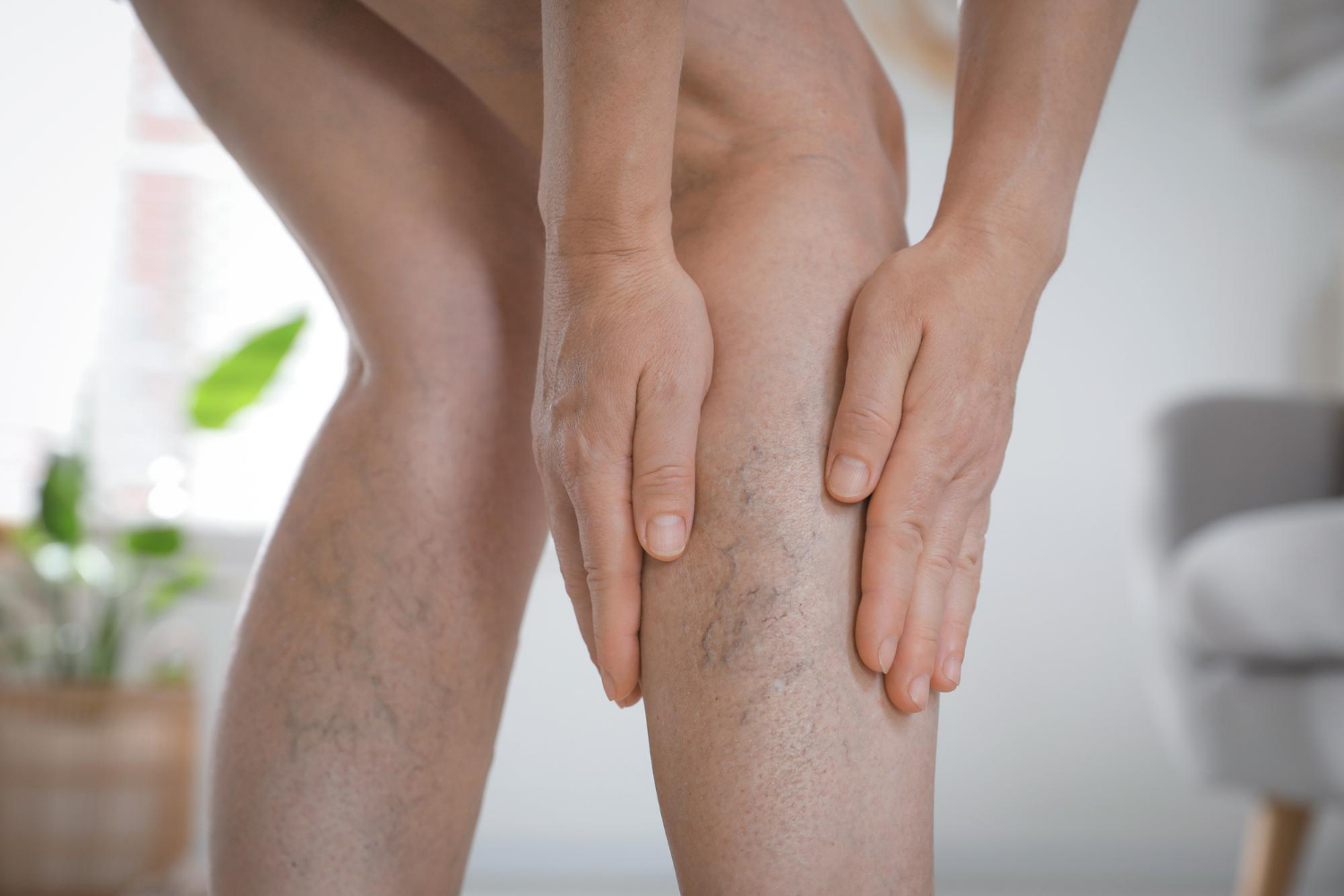 Vein Self-Check: Spider vs Varicose Veins vs DVT Red Flags and Urgency
