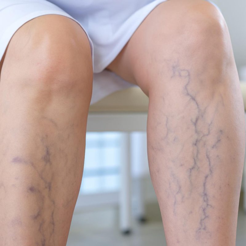 varicose vein removal