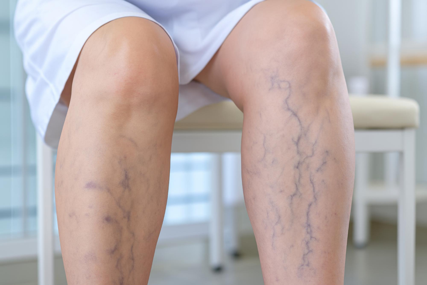 Comparing Non-Surgical Varicose Vein Removal Options
