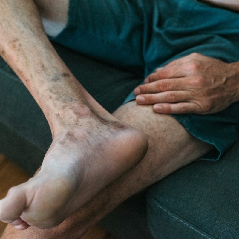 varicose veins