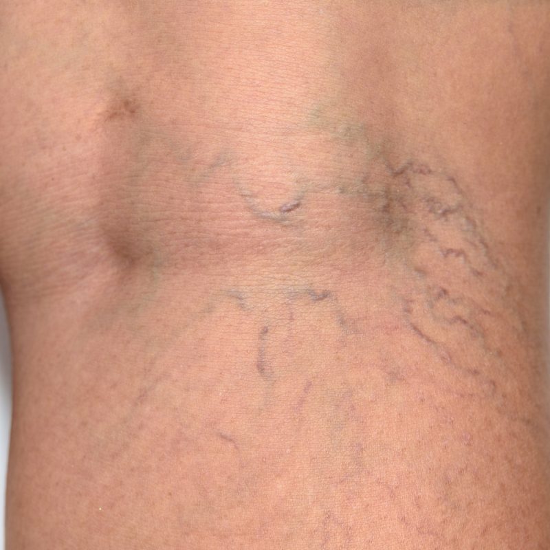 Spider Vein