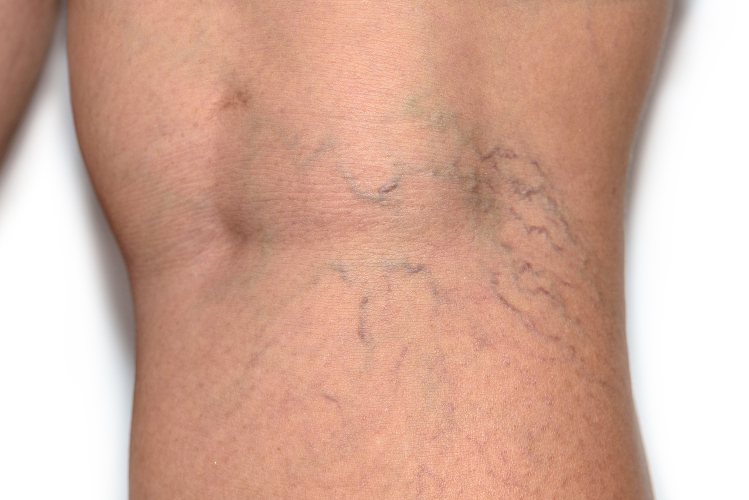 Questioning Spider Vein Sclerotherapy Treatment Before You Start